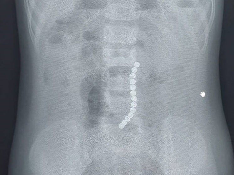 Двухлетняя девочка проглотила чертову дюжину магнитов